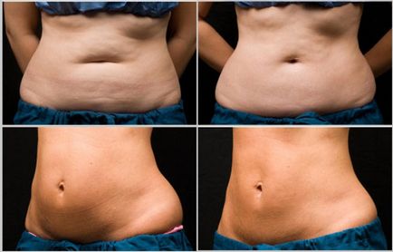 Maseaza abdomen după naștere, atunci când se poate face masaj pentru abdominoplastie, poate exista un vid, este posibil