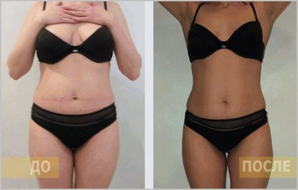 Maseaza abdomen după naștere, atunci când se poate face masaj pentru abdominoplastie, poate exista un vid, este posibil