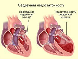 A kezelési módszerek a szívelégtelenség - szív kezelésére