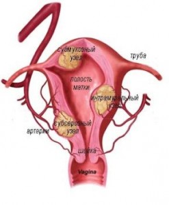 Fibroame uterine tratamentul fibromului uterin remedii populare și metode