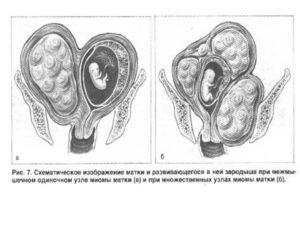 Myomul speciei uterine, patogeneza, simptomatologia și tratamentul