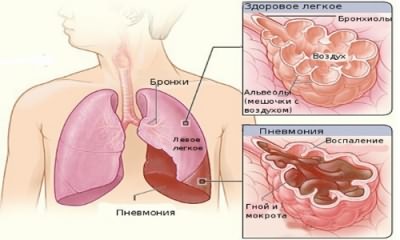 Чи можна паритися в лазні при гаймориті