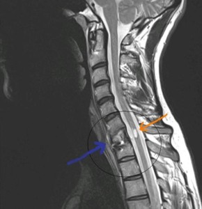 MRI a nyaki gerinc