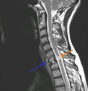 Mert a coloanei vertebrale cervicale