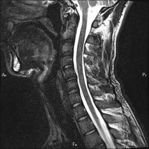 Mert a coloanei vertebrale cervicale