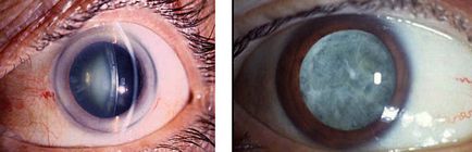 Umflarea tratamentului cu ochi de cataractă și efectele negative ale metodelor populare
