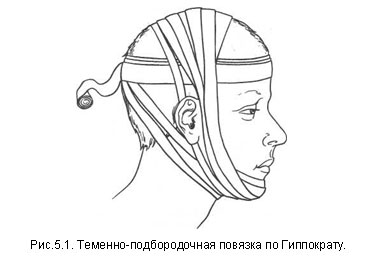 Накладення пов'язок при переломах щелепи