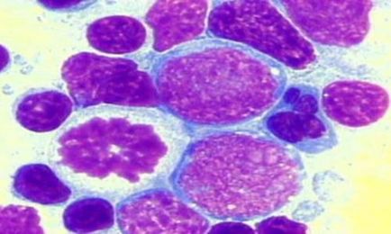 Non-Hodgkin lymphoma, ami azt jelenti, tünetei és kezelése a rák