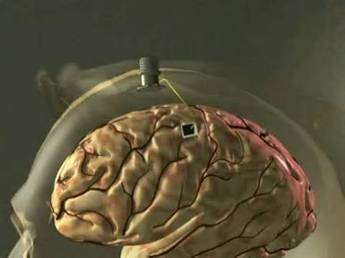 Neural chips, agyi chip implantátumok és az agy-gép interfész programot ( «brain-gép