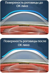 Нічні лінзи (ортокератология) - тимчасова корекція зору за допомогою жорстких контактних лінз