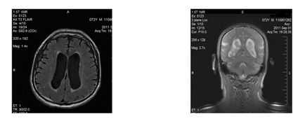 Normál nyomáson hydrocephalus ( «normál» agy-gerincvelői folyadék) normál nyomású hydrocephalus