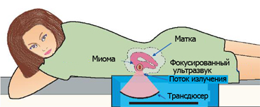 Операції при міомі тіла матки