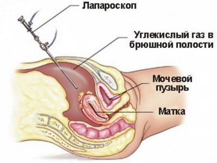 Operații cu miom de corp al uterului