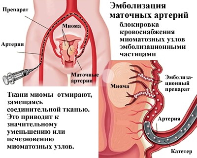 Operații cu miom de corp al uterului