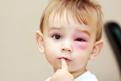 Umflarea ochilor la copil cauzele principale, primul ajutor