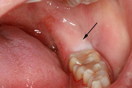 Umflarea gingiei dupa indepartarea umflarii dintelui de intelepciune, ce trebuie facut daca doare, inflamatie, tratament dentar