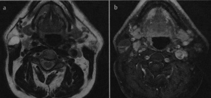 Tumor wortina-adenolimfom