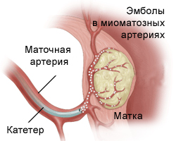 Органозберігаючі методи лікування міоми матки