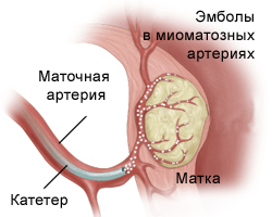 Ablációs kezeléstől méh mióma