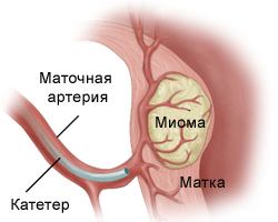 Органозберігаючі методи лікування міоми матки