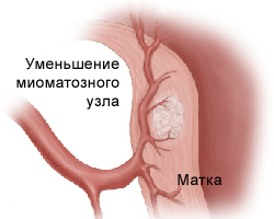 Аблационни лечение на маточни фиброиди