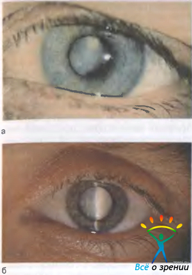 Ускладнення набухає катаракти ускладнення відновлення зору