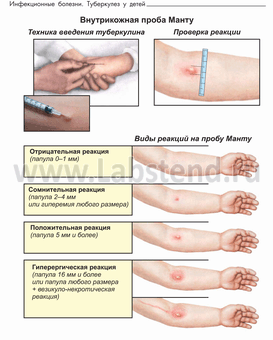 Din care vaccinul - o mostră de mantu - nu trece