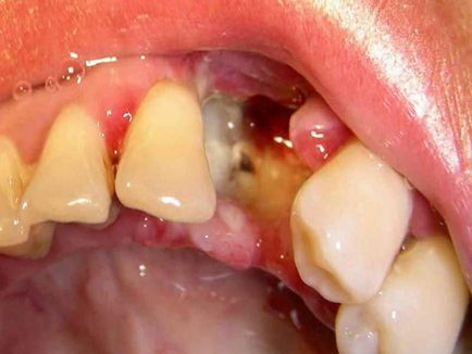 Набряк після видалення зуба як зняти в домашніх умовах фото