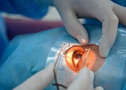 Tratamentul detașării retinei - costul chirurgiei