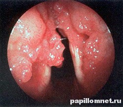 Папіломатоз гортані і мигдалин симптоми, профілактика та лікування
