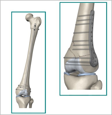 Fractura femurului (diafiza)