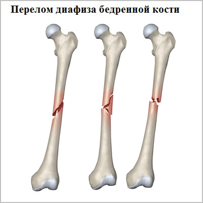 Перелом стегнової кістки (діафіз)