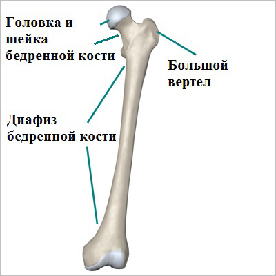 Fractura femurului (diafiza)