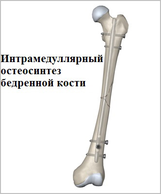 Перелом стегнової кістки (діафіз)