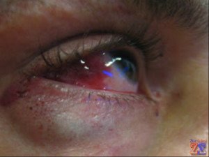 Primele simptome și cauze ale cataractei