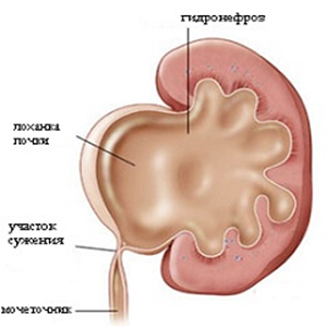 Піелоектазія нирок у плода клінічні прояви і причини