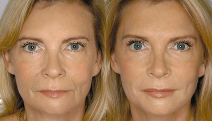 Chirurgie plastica faciala - de ce este necesar, caracteristicile procedurii