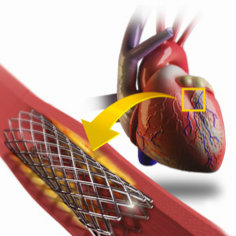 Побічні ефекти стентування серця, як схуднути