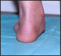 Artroza subtalară - operația de fixare a implantului în sinusul piciorului