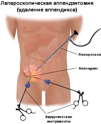 Postoperatorie după apendicită - cum trece ea