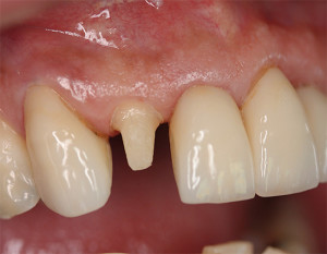 Препарування зубів під коронки, під металокераміку особливості і ціни в москві