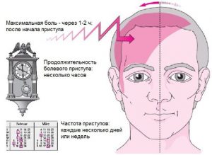 Ознаки мігрені, cімптоми, як виявляється біль