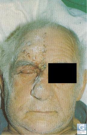 Probleme de piele la vârstnici (rusă) - globală dermatologie