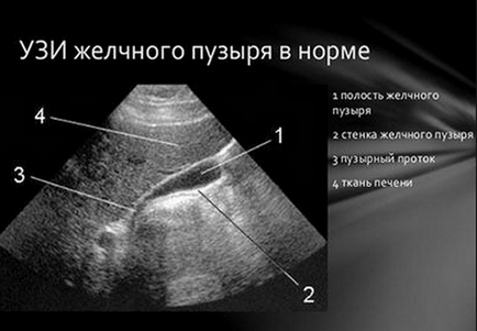 Розміри жовчного міхура в нормі у дорослих і дітей