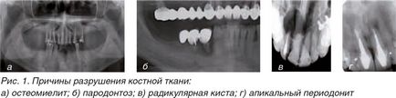 Регенерація кісткової тканини в стоматології