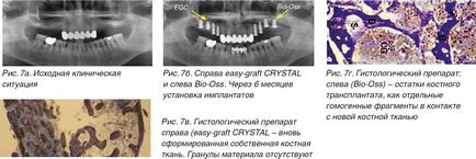 Regenerarea țesutului osos în stomatologie