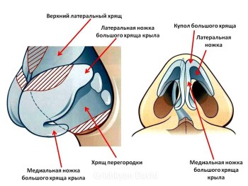 Rinoplastia vârfului nasului, operație pe nas înainte și după, fotografie