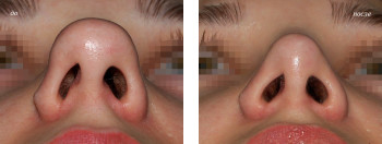 Rinoplastia vârfului nasului, operație pe nas înainte și după, fotografie