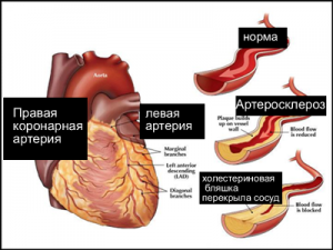 Серцева недостатність лікування