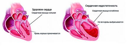 Серцева недостатність лікування